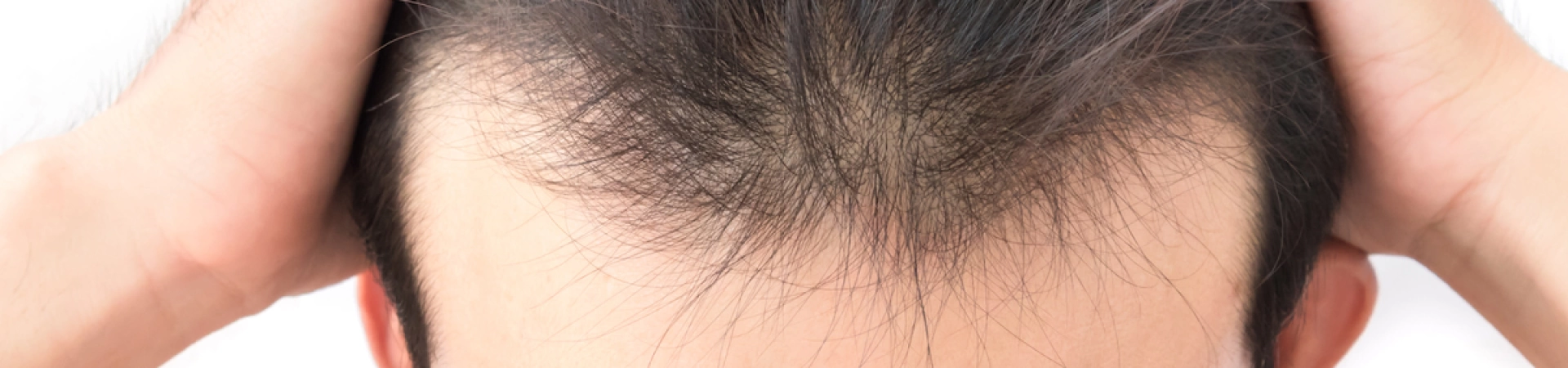 Первые признаки алопеции