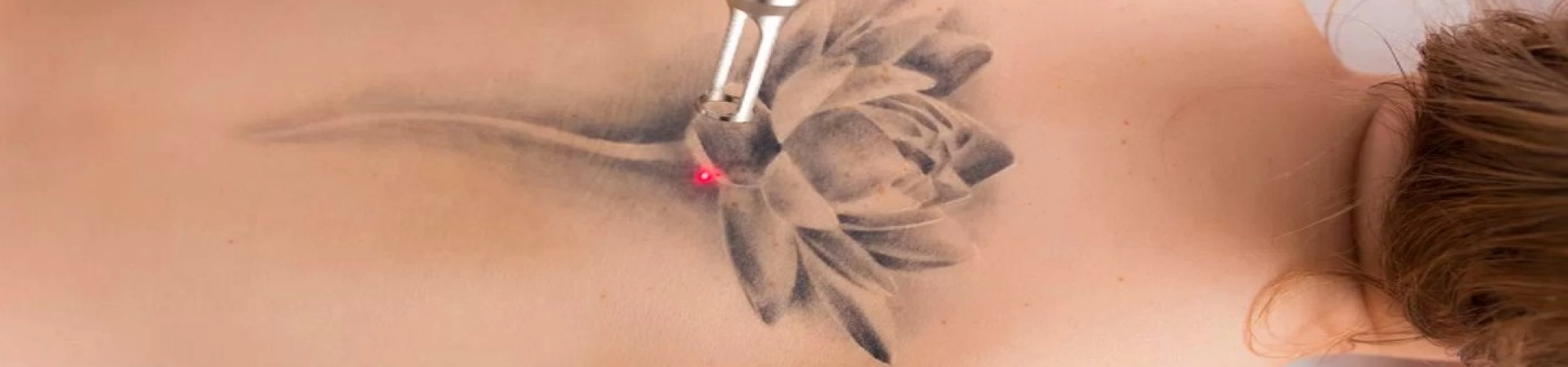 Что стоит знать, прежде, чем удалить татуировку лазером?