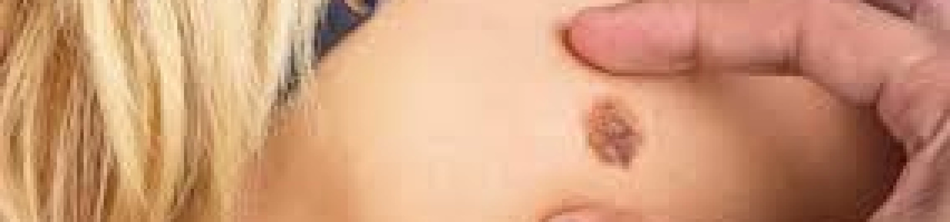 Новообразования кожи. Меланома: кто в зоне риска?