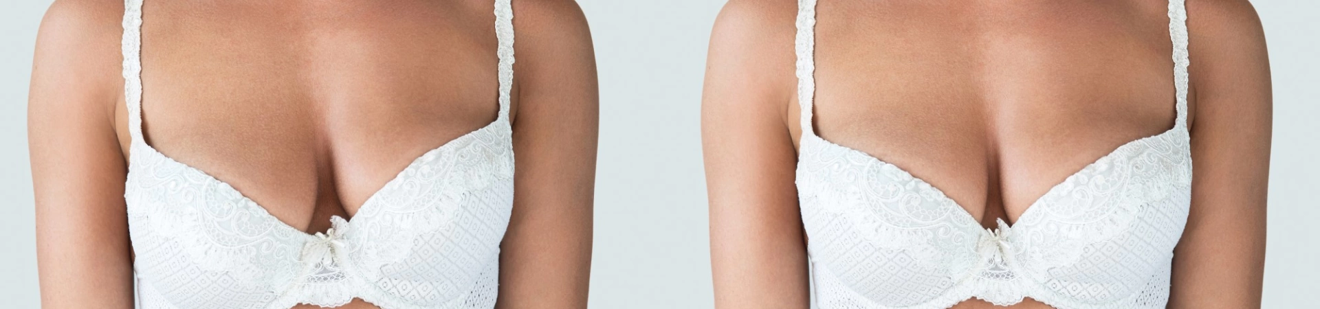 Асимметрия груди — причины, коррекция