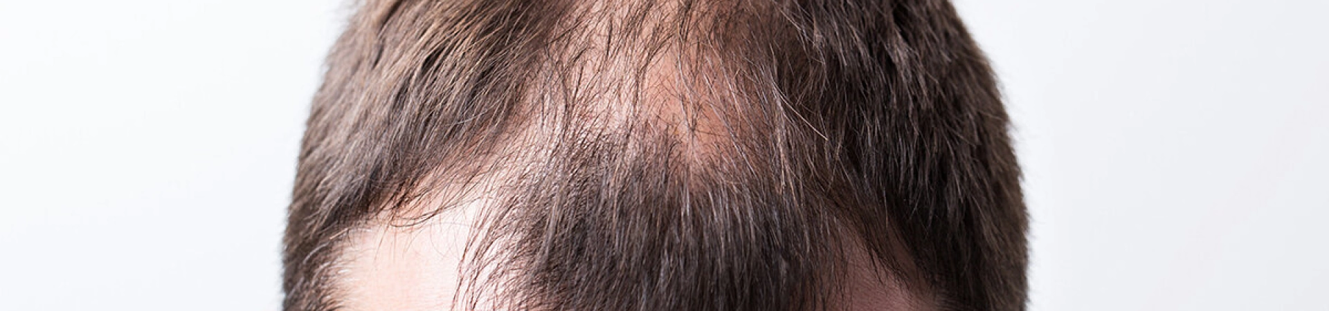 Пересаженные волосы — это навсегда?