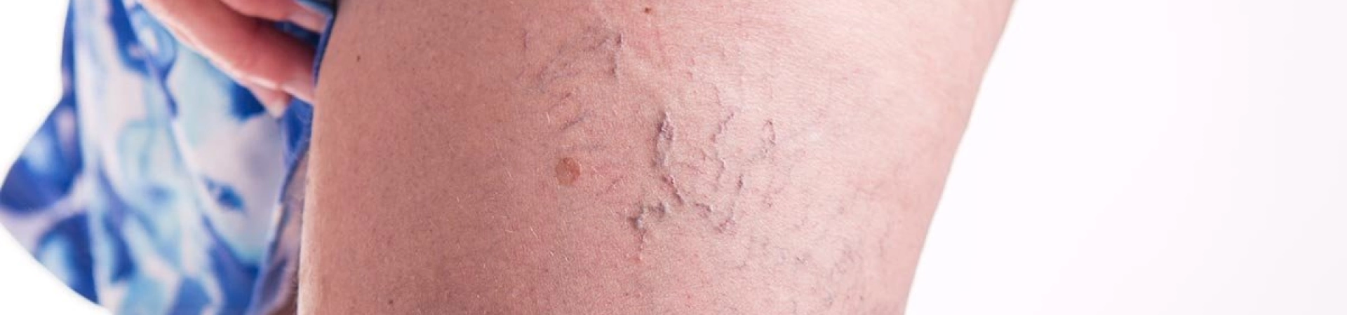 5 мифов о варикозном расширении вен