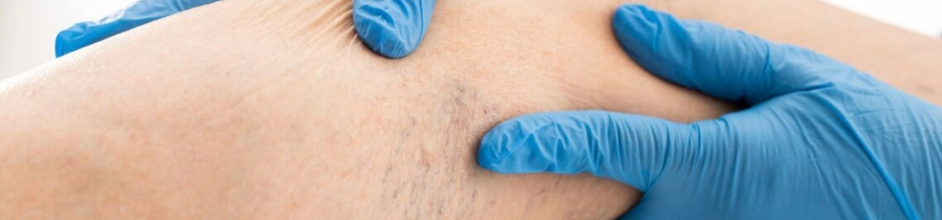 Варикоз: что нужно знать о подготовке к операции и восстановлении после нее?