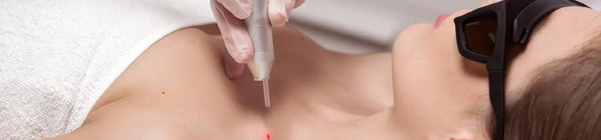 Почему эффективнее удалять новообразования лазером