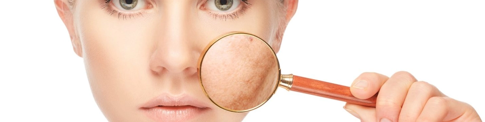 Лечение глубокой пигментации