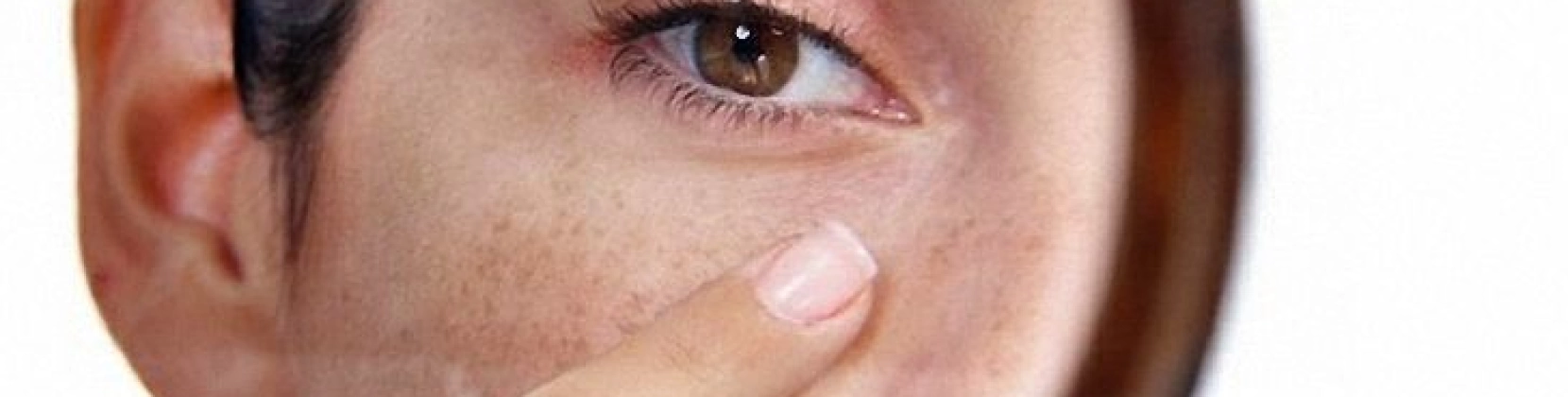 Лечение поверхностной пигментации