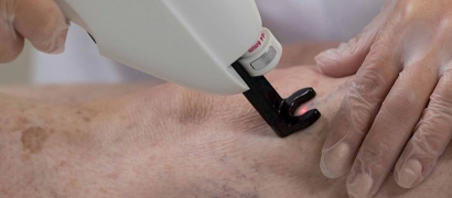 Лазерное удаление мелких вен на ногах