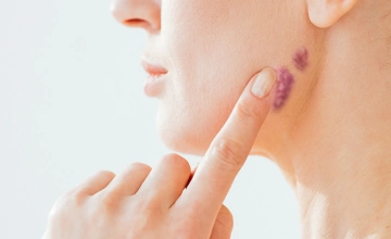 Удаление гемангиом