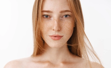 Лечение глубокой пигментации лазером (мелазмы)