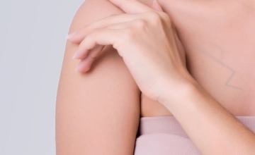 Удаление вен (сосудистых патологий) на груди лазером