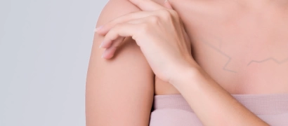 Удаление вен (сосудистых патологий) на груди лазером