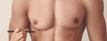 Удаление гинекомастии