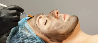 Лазерный карбоновый пилинг