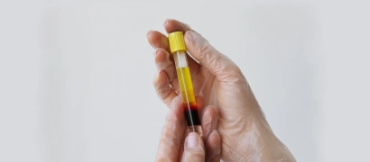 Плазмотерапия