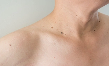 Удаление бородавок и папиллом