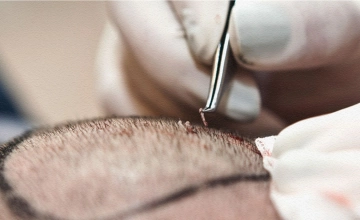 Трансплантация волос в ШайнЭст