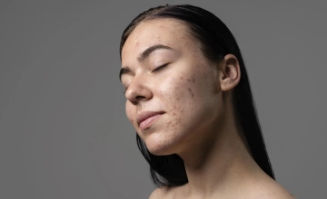 Лазерное лечение постакне