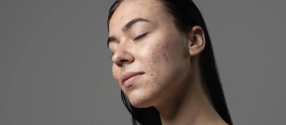 Лазерное лечение постакне