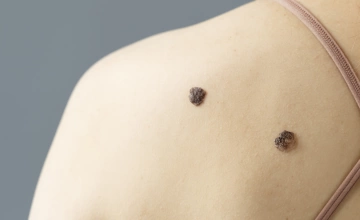 Удаление родинок