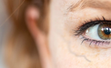 Лечение периорбитальных вен (удаление вен вокруг глаз)