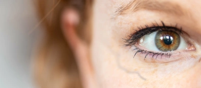 Лечение периорбитальных вен (удаление вен вокруг глаз)