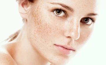 Лечение поверхностной пигментации фотонасадкой