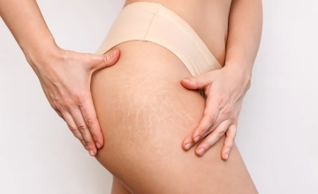 Лазерное удаление растяжек