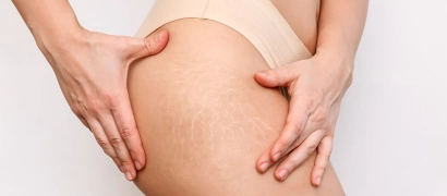 Лазерное удаление растяжек