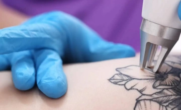 Удаление татуировок