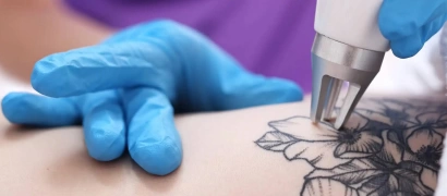 Удаление татуировок