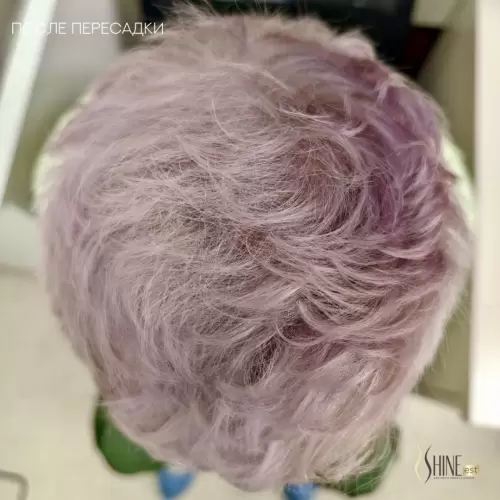 После пересадки | Shine-est.by