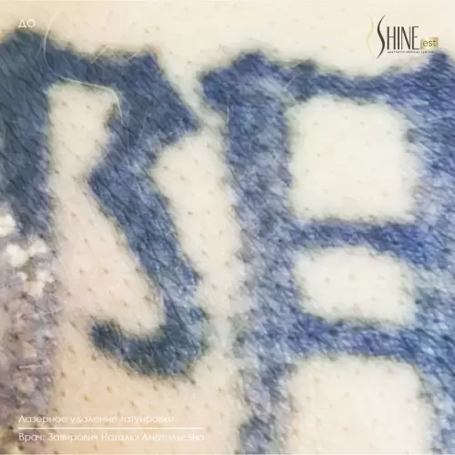 До удаления | Shine-est.by