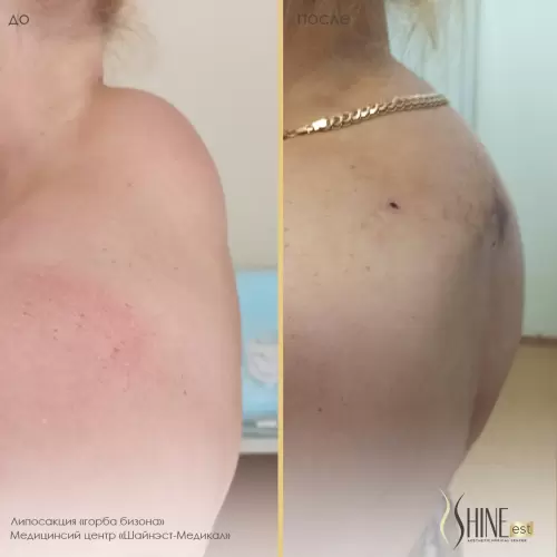 Липосакция 