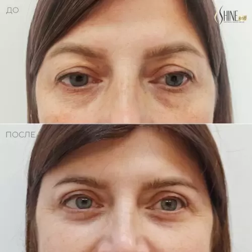Круговая блефаропластика | Shine-est.by