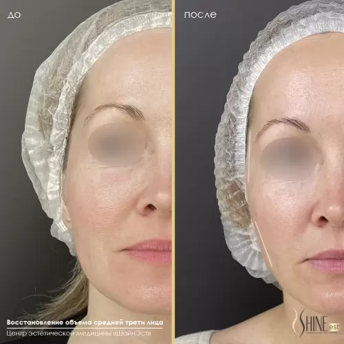 Объемная коррекция висков и средней трети лица филлером на основе гиалуроновой кислоты | Shine-est.by