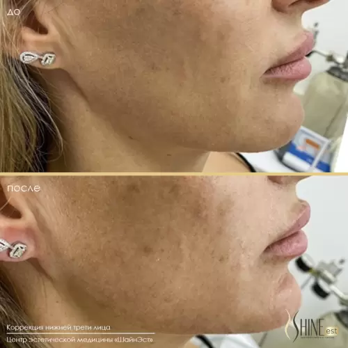 Коррекция нижней трети лица | Shine-est.by