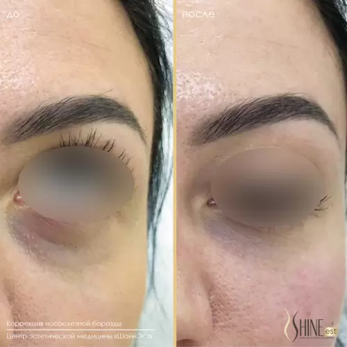 Коррекция носослезной борозды | Shine-est.by