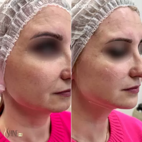 Коррекция средней и нижней трети лица филлером на основе гиалуроновой кислоты | Shine-est.by