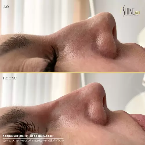 Коррекция спинки носа филлером | Shine-est.by