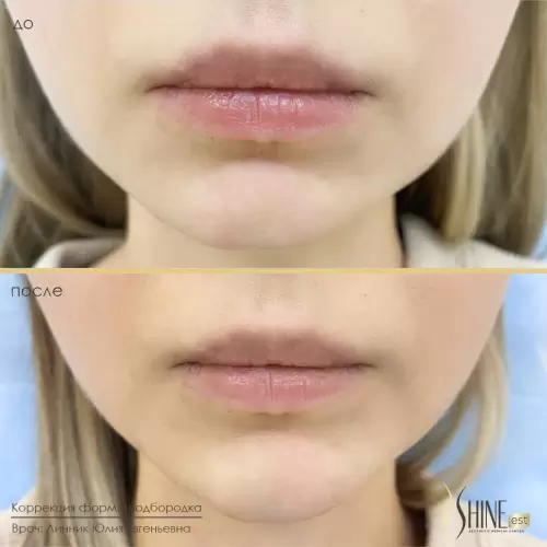 Коррекция формы подбородка филлером | Shine-est.by