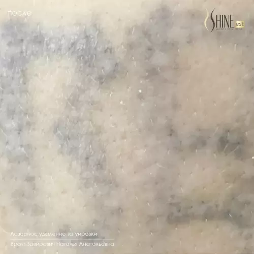 После удаления | Shine-est.by