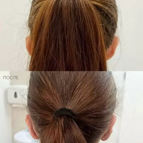 Устранение лопоухости | Shine-est.by