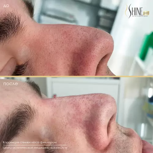 Коррекция спинки носа филлером | Shine-est.by