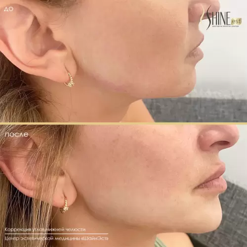 Коррекция углов челюсти | Shine-est.by