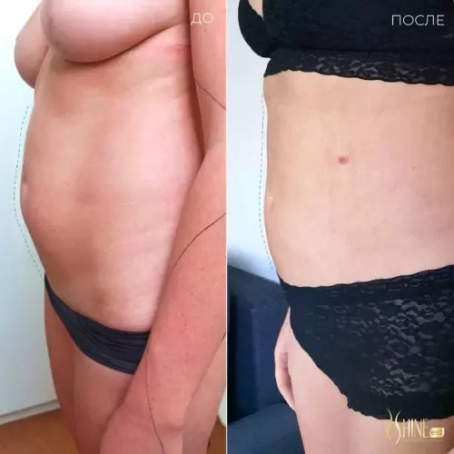 Лазерная липосакция передней стенки живота | Shine-est.by