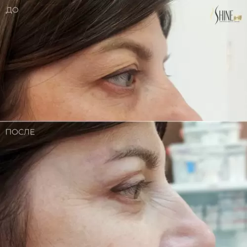 Круговая блефаропластика | Shine-est.by