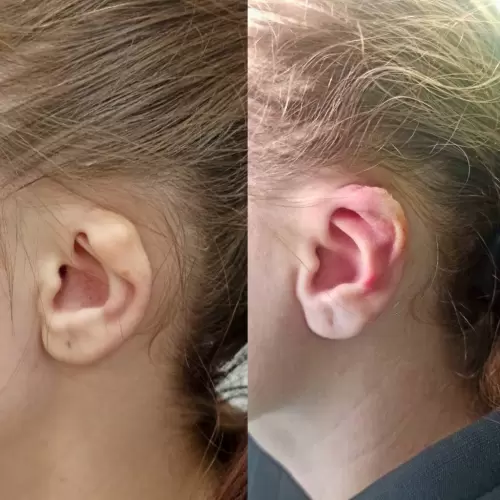 Реконструкция завитка | Shine-est.by