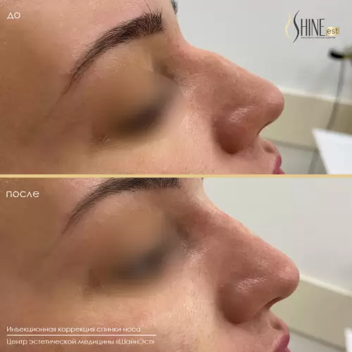 Коррекция спинки носа филлером | Shine-est.by
