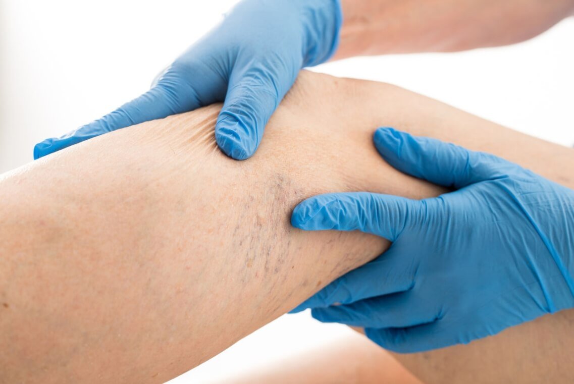 Варикоз: причины, симптомы и лечение