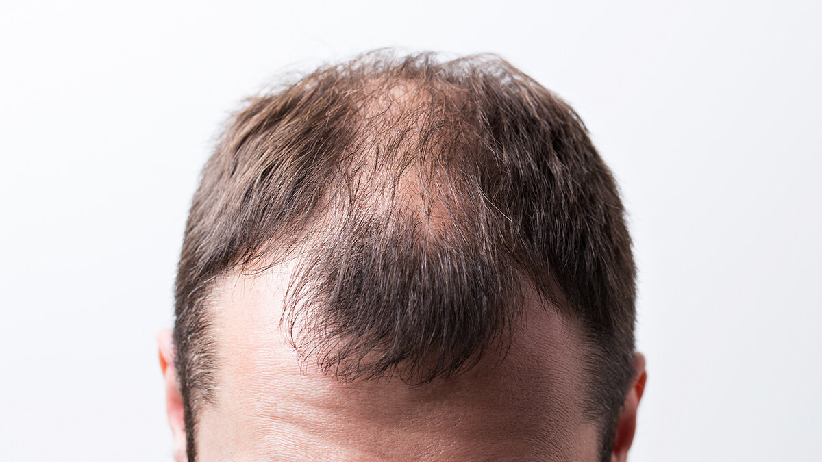 Пересаженные волосы — это навсегда?